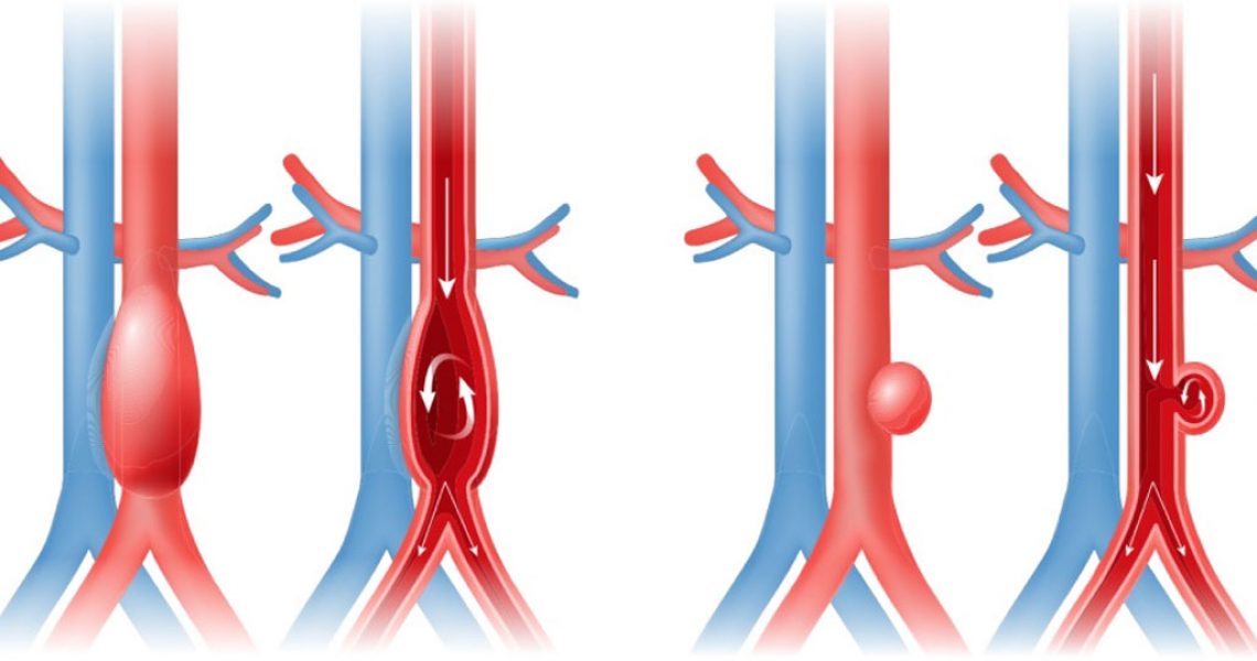Treatment-of-aneurysms